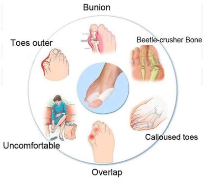 Picture of ANTI CRACK TOE PROTECTOR SILICON