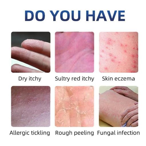 Picture of Anti Fungal Cream Fungal Cream Fungal Malam  Skin Care Cream ungal Malam for Ringworm itching Eczema cream