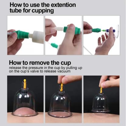 Picture of 12 CUPS SETS FOR CUPPING MASSAGER