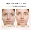 Picture of Electronic Acne Patches Therapy Pimple Patch Red Light Zit Patches ACNE PATCH